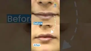 Lip Filler Before After Result | Before After of Lip Fillers