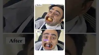 Yellow + Purple = White | Get Whiter Teeth Instantly Without Bleach #teethwhiteningathome #shorts