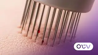 ماذا يعني Collagen Induction Therapy وكيف يعمل؟