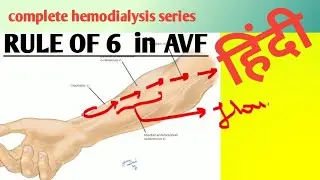RULE OF 6 IN AVF /HEMODIALYSIS SERIES in हिंदी / HINDI /VIDEO 206