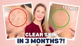 Acne Success Story: Clear Skin After $1,000s on Failed Acne Fixes