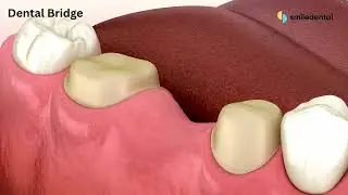 Dental Bridge Procedure