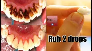 Rub only 2 drops on your Gums and teeth  You Will No Need To Visit Your Dentist again!