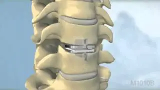 頸椎間盤突出,  頸椎間盤突出手術, 椎間盤突出微創手術 - www.brain-spine.com.hk