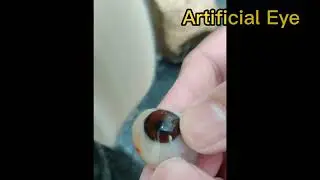 Best Artificial Eye Lab in Bangladesh, Custom Made Ocular Prosthetic Eye.