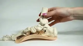 Bunions, How Natural Foot Orthotics Help