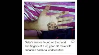 Osler's Node (Infective Endocarditis, Immune Complex Deposition)