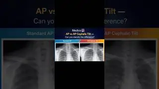 x ray made easy #clavicle #medicalshorts #medicolife #medicalstudent #xraytechnicians #xray #medico