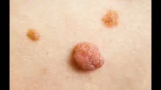 Skin tags healing tips 