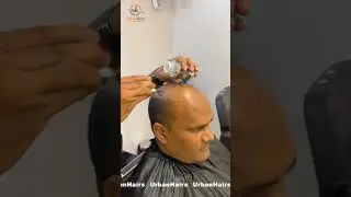Non Surgical Hair Replacement | UrbanHairs
