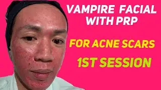 ACNE SCAR TREATMENT | MICRONEEDLING WITH PRP | Vampire facial | 1st session