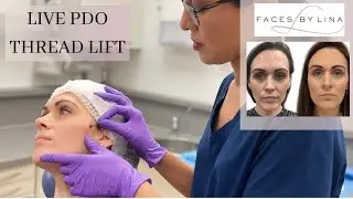 Watch the PDO Thread Lift in Action! Say Goodbye to Nasolabial Folds and Marionette Lines!