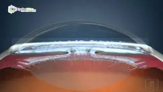 Dr. Max Raynor - Glaucoma
