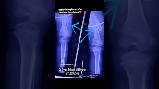 Why children hardly need surgery after a fracture!