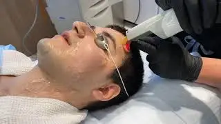 PART 2: CUTERA EXCEL V FOR FACIAL REDNESS, ACNE, AND TO IMPROVE SCAR PIGMENTATION | DR. JASON EMER