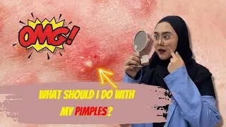 5 Worst Foods to Avoid to Prevent Acne | #acne