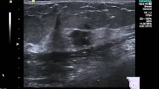 Breast Ultrasound   cancer 2