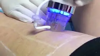 Fractional rf microneedle skin tightening stretch mark removal machine rf-1 treatment video