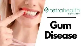 Gum Disease - Manhattan, NY - Dr. Alexander Volchonok