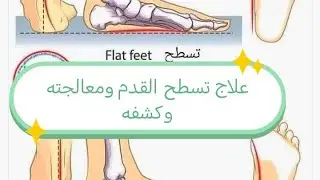 شرح ومعالجة تسطح القدم لاجتياز الاختبار العسكري