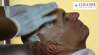 How to wash your head after getting a hair transplant
