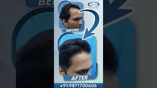 Best Hair Transplant Clinic in Delhi | Before After Best Results | Cost of Hair Transplant in Delhi