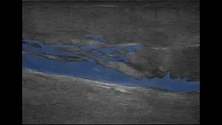 Necrotizing fasciitis diagnosed on ultrasound. 5/2021