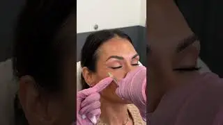 Get Rid of Crows Feet with This Treatment  #beauty #skincare