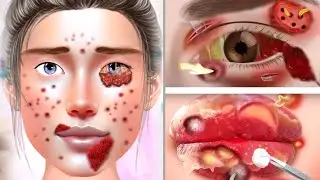 ASMR Remove Big Acne And Genital Warts Infected Fece | Deep Cleaning Animation |