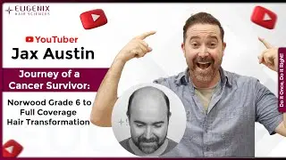Journey of a Cancer Survivor: Norwood Grade 6 to Full Coverage Hair&nbsp;Transformation