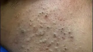 [ASMR] Глубокое очищение и отшелушивание лица для чистой кожи и профилактики прыщей