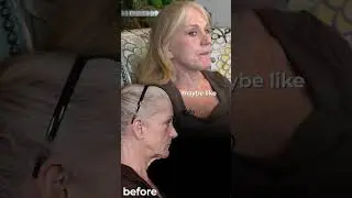 My FACELIFT Journey