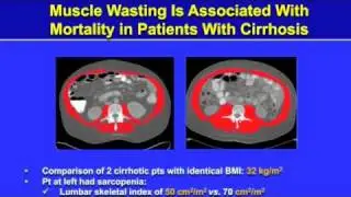 Muscle Wasting Is Associated With Mortality in Patients With Cirrhosis