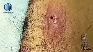 Huge Inflamed Cyst and Zit Removal &ndash; Don&rsquo;t Watch While Eating! #38 #funny #cat #cute #cyst