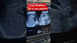 Rare case of 2 Gallbladders in 1 person? 😱 Rare Ultrasound Case You Won&rsquo;t Believe!