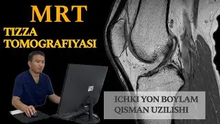 Тизза томографиясини урганамиз, МРТ коленного сустава, ichki yon boylam qisman uzilishi, tizza MRT