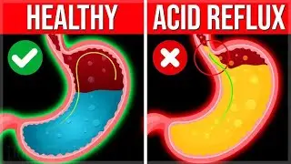 10 Natural Ways To Reduce Acidity | How to Stop Acid Reflux Fast