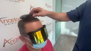 ⭐⭐⭐⭐⭐Case #217 - &Delta;&epsilon;ί&tau;&epsilon; &tau;&omicron; &alpha;&pi;&omicron;&tau;έ&lambda;&epsilon;&sigma;&mu;&alpha; &mu;&epsilon; 2500 FUs - Anastasakis Hair Clinic