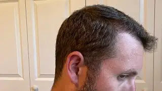 Day 145 Results - FUE Hair Transplant - Take Care Of Yourself