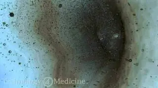 PIPS 3D Animation | LightWalker Dental Laser