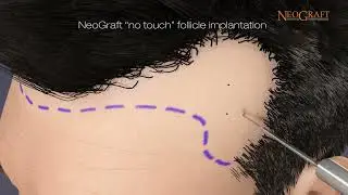 Neograft FUE Hair Transplant procedure IHRS Jacksonville Florida