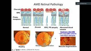 Targeting Mitochondria to Treat Age-related Macular Degeneration, Deborah A. Ferrington, PhD - UCI