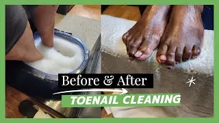 Deep Sidewall Toenail Cleaning: Ari_InfinitePOV