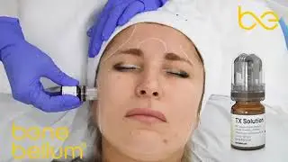 Benebellum applicatie - Behandeling van hyperpigmentatie en melasma van Skin Tech Pharma