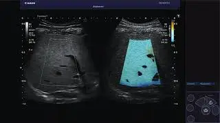 3 ATI Liver Steatosis _ Analiza zwłóknienia wątroby _ Canon Medical