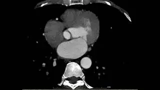 Ct Cag #Ctcoronaryangiography #ctCAG #angiography #heartangiography #CTscan #mricardiac #mri #corona