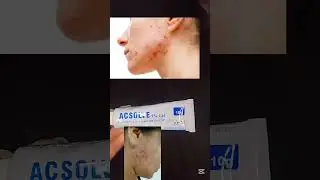 acsolve gel #viral #oilyskincareroutine