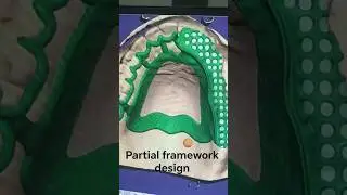 exocad partial framework design