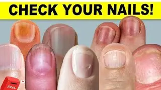 Not Just For Scratching: NAILS ARE CLUES TO  YOUR HEALTH