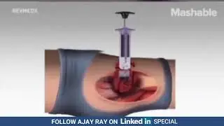 Xstat stops bleeding from gunshot wounds in seconds